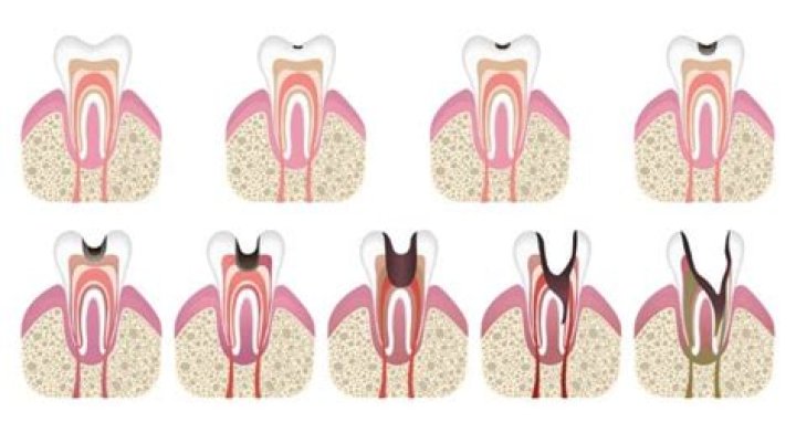 Will cavity heal itself?