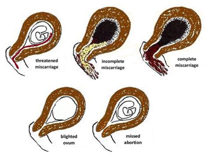 Will embryo cause miscarriage?