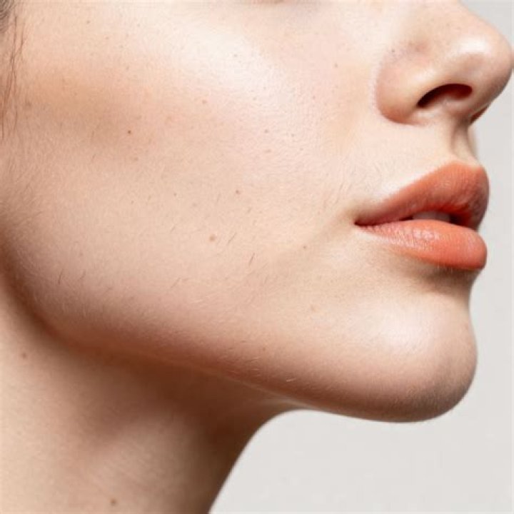 Will losing weight stop hirsutism?